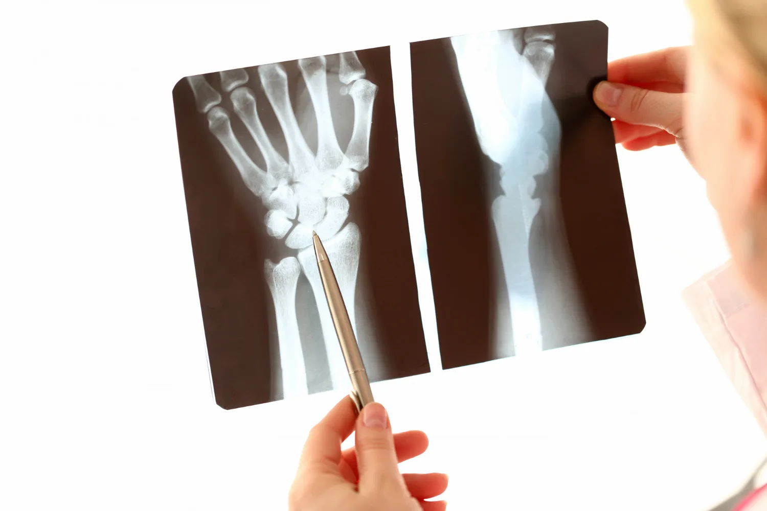 Reducción de fracturas de traumatologia